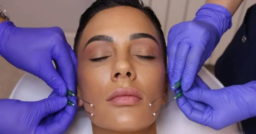 Lifting siluet soft nitima poliklinika Diva