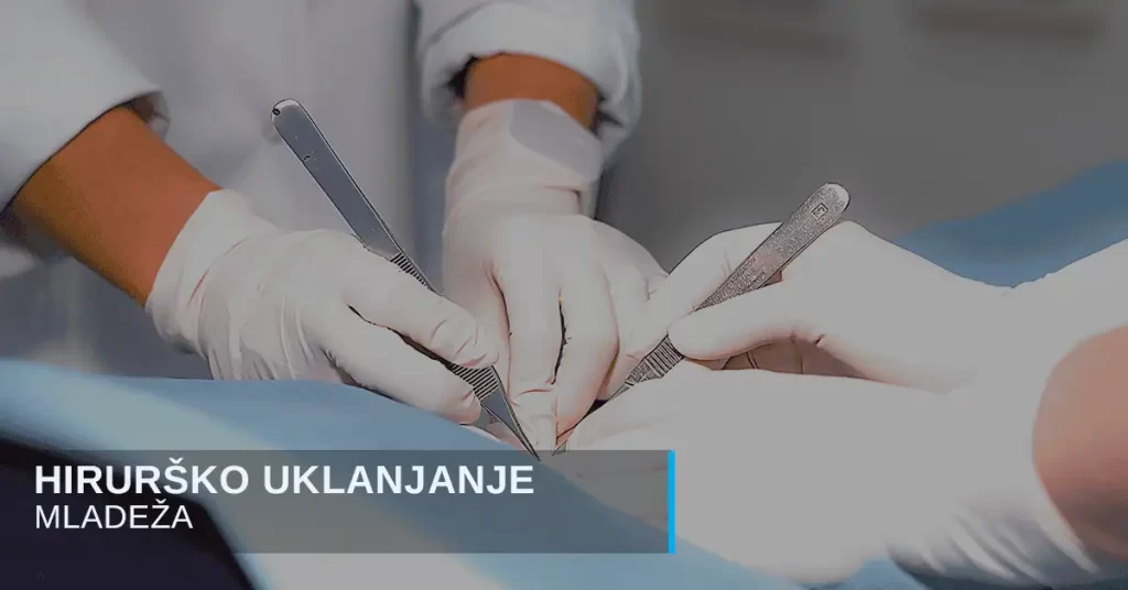 Hirurške intervencije se u poliklinici Diva dr Bogdanović obavljaju u lokalnoj anesteziji