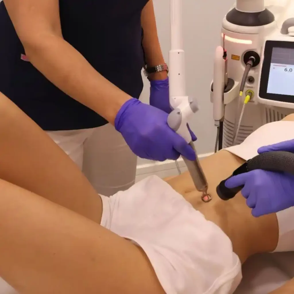 Lasersko uklanjanje strija poliklinika Diva dr Bogdanović Beograd