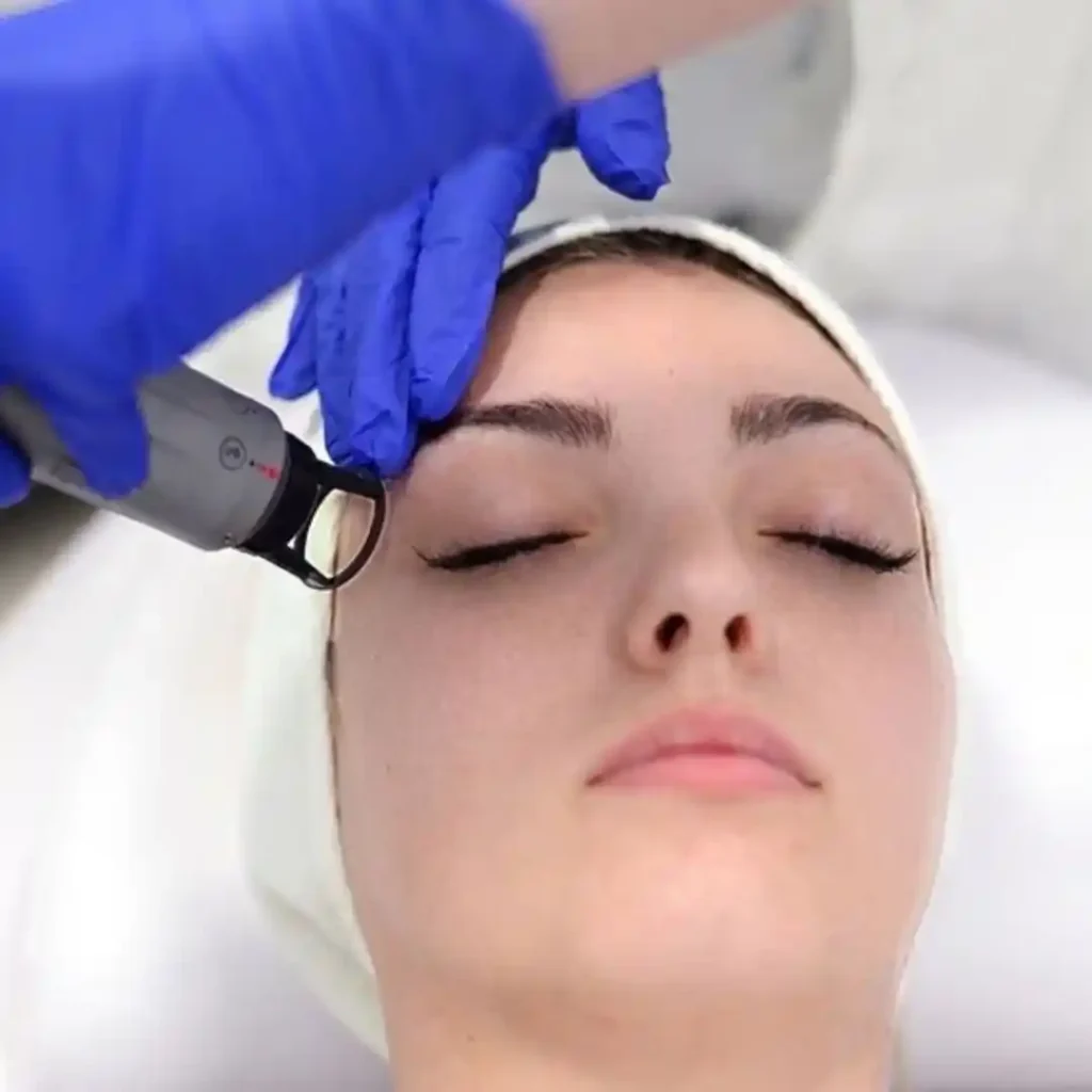 Nano Q lasersko zatezanje kapaka poliklinika Diva dr Bogdanović