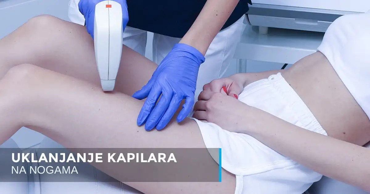 Uklanjanje kapilara na nogama laserom