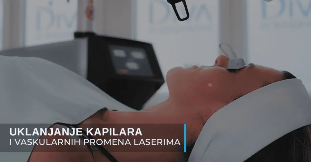Uklanjanje kapilara i vaskularnih promena na licu i dekolteu