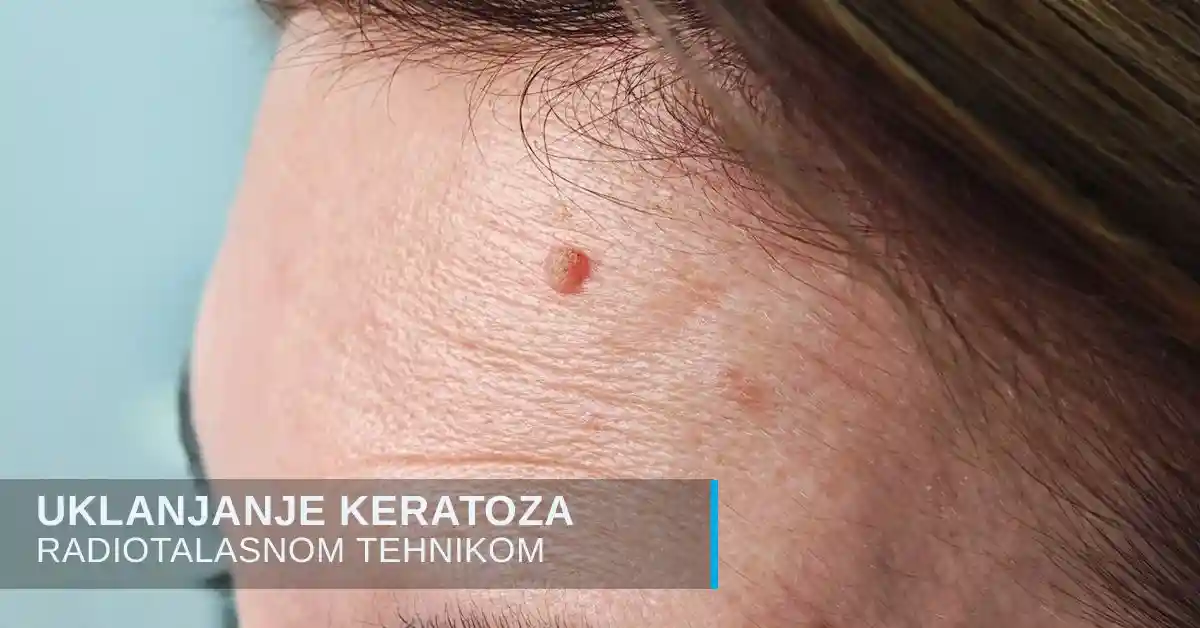 Uklanjanje keratoza radio-talasima u poliklinici Diva dr Bogdanović Beograd