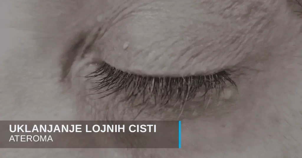 Uklanjanje lojne ciste ateroma