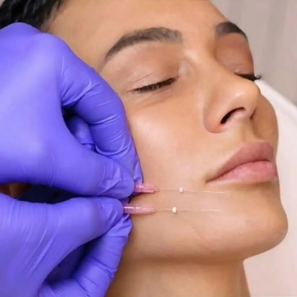 3D mezoniti za neoperativni lifting lica u poliklinici Diva Beograd