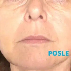 Cog niti lifting iskustva posle