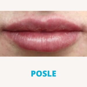hijaluron-usne-iskustva-posle-poliklinika-diva-300x300 (1)