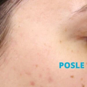 laser za ožiljke od akni - iskustva posle - poliklinika Diva