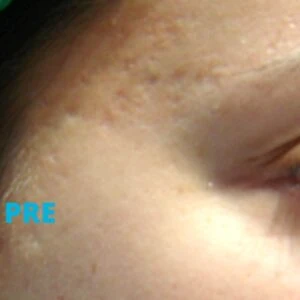 Laser za ožiljke od akni - iskustva pre - poliklinika Diva