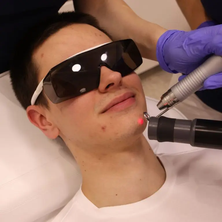Lasersko uklanjanje ožiljaka od akni poliklinika Diva Beograd