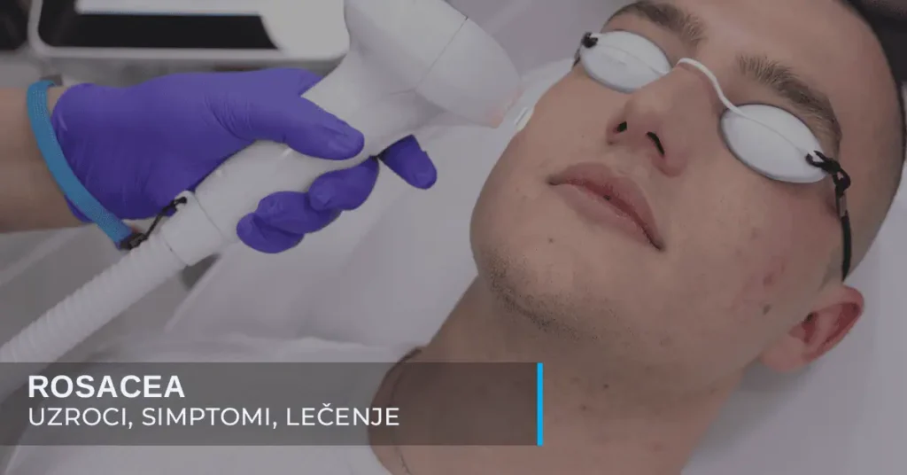 Lečenje rosacea-e laserom