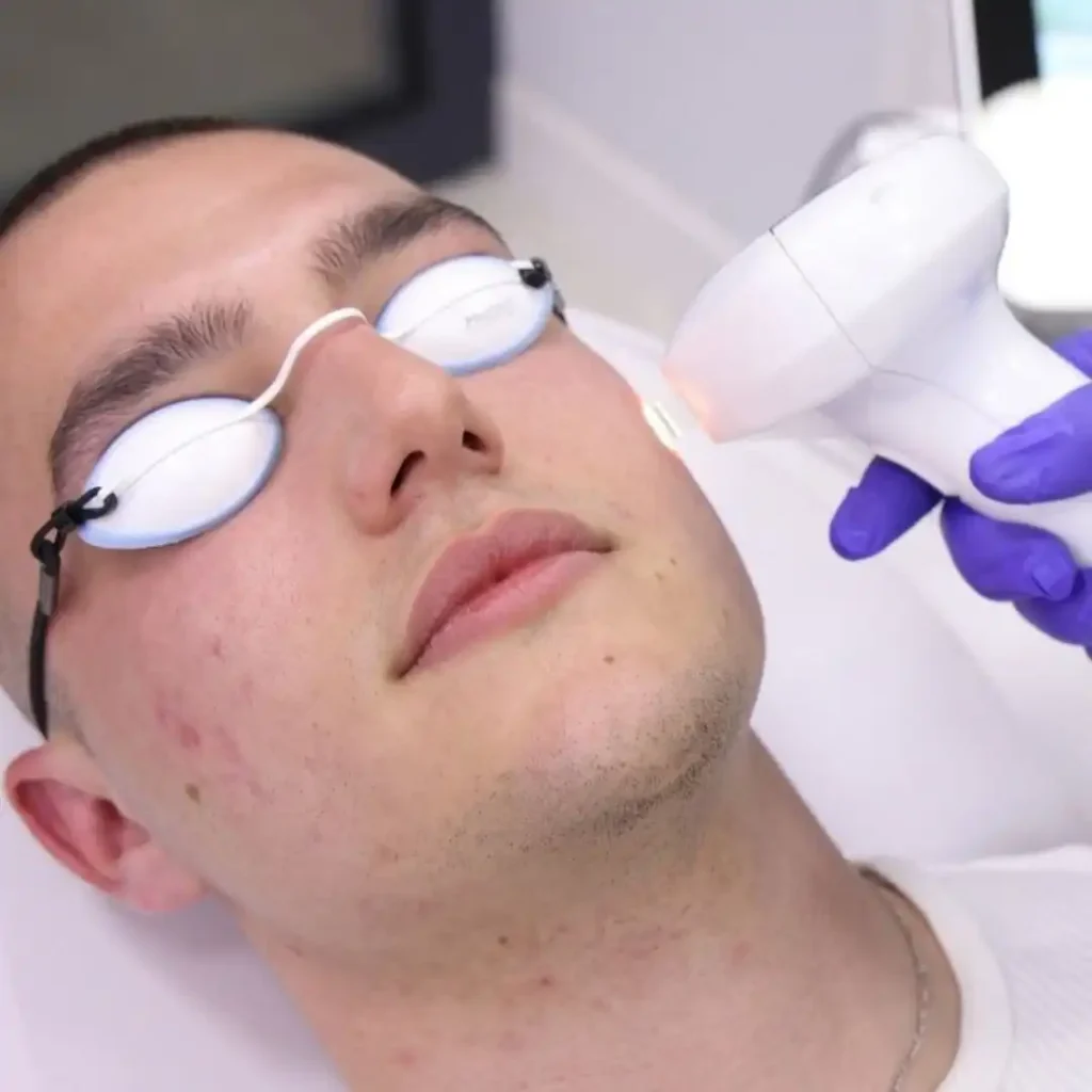 Ožiljci od akni lasersko uklanjanje Frakcionisanim i 4D Combo laserom poliklinika Diva dr Bogdanović