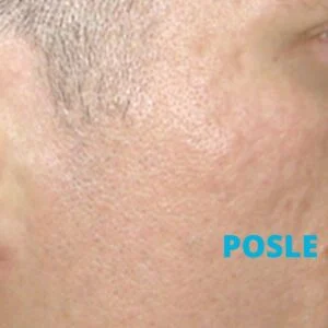 Ožiljci od akni lasersko uklanjanje iskustva posle - poliklinika Diva