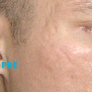 Ožiljci od akni lasersko uklanjanje iskustva pre - poliklinika Diva dr Bogdanović