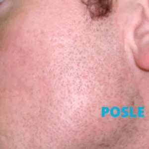 Ožiljci od akni - posle - iskustva - poliklinika Diva