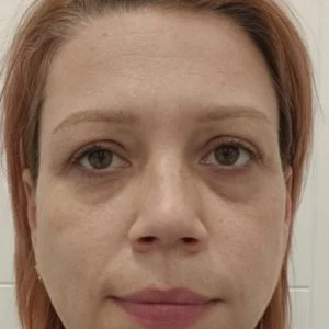 Podmlađivanje lasrom Twinlight iskustva - posle - poliklinika Diva Beograd