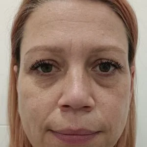 Podmlađivanje laserom Twinlight iskustva - pre - poliklinika Diva dr Bogdanović