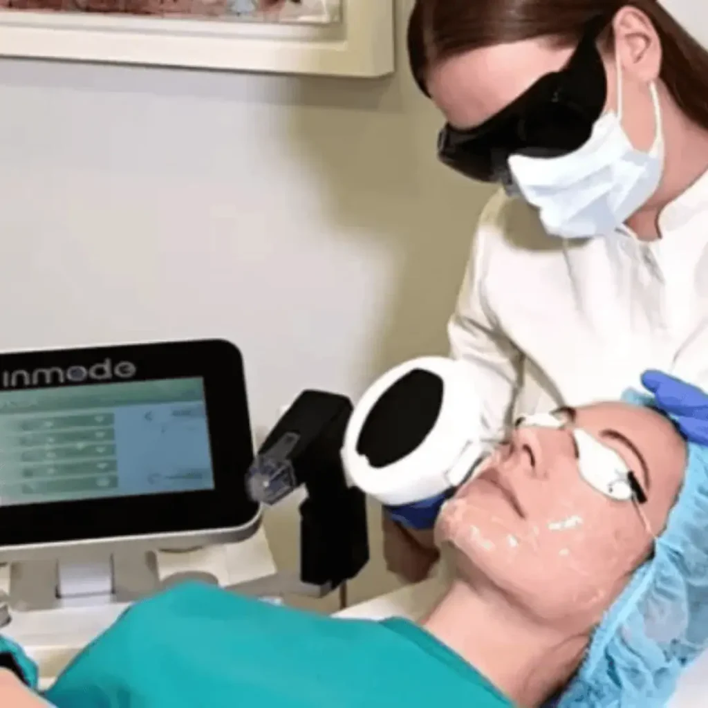 Lečenje rosacea-e laserom