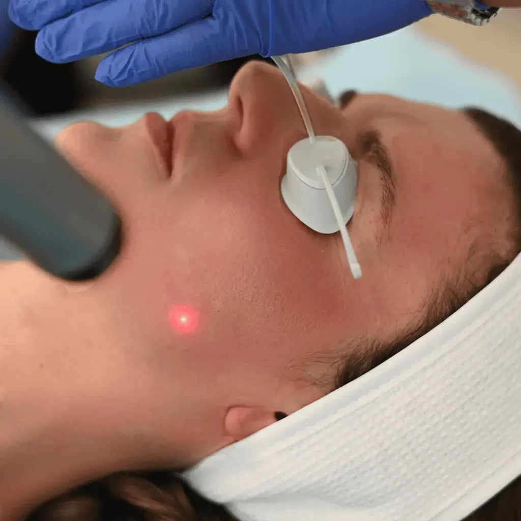 Rosacea na licu