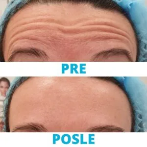 Uklanjanje bora čelo - pre i posle iskustva poliklinika Diva