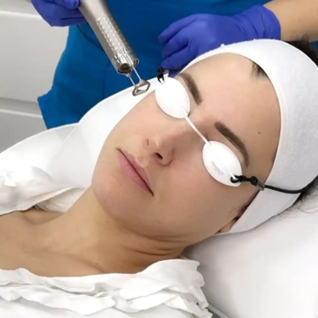 Uklanjanje ožiljaka od akni laserima poliklinika Diva dr Bogdanović