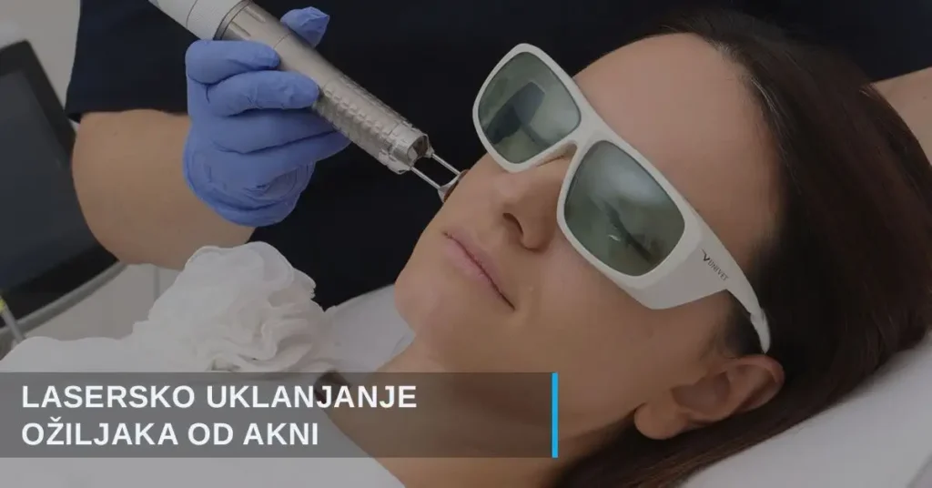 Uklanjanje ožiljaka od akni