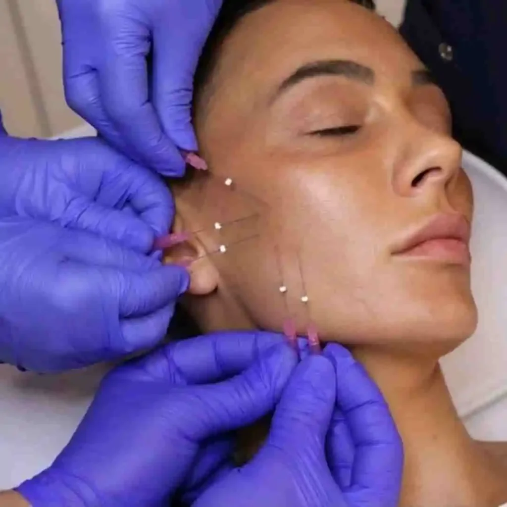 Zatezanje kože lica i lifting lica 3D mezonitima u poliklinici Diva dr Bogdanović