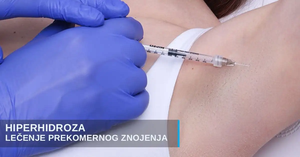 Hiperhidroza - preterano znojenje lečenje poliklinika Diva