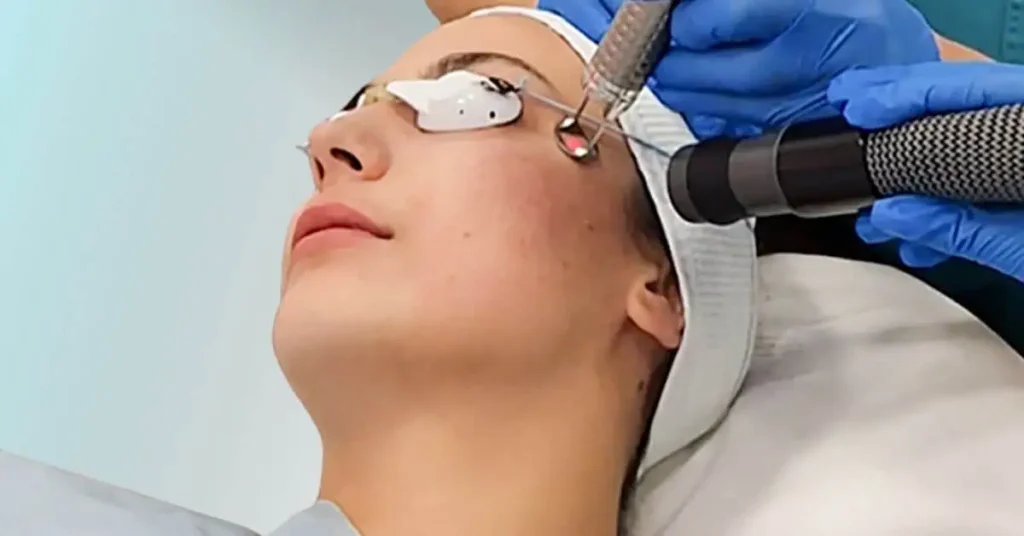 Ožiljci od akni uklanjanje laserom poliklinika Diva dr Bogdanović