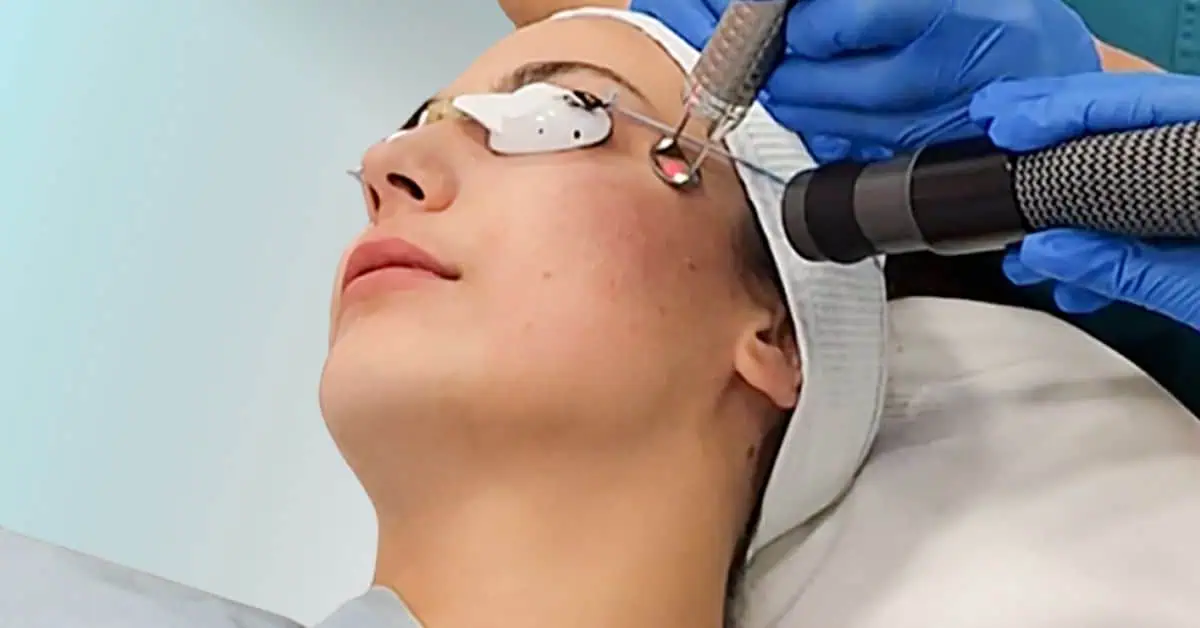 Ožiljci od akni uklanjanje laserom poliklinika Diva dr Bogdanović