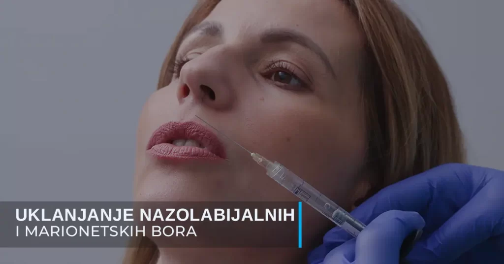 Uklanjanje nazolabijalnih bora i marionetskih bora hijaluronom poliklinika Diva