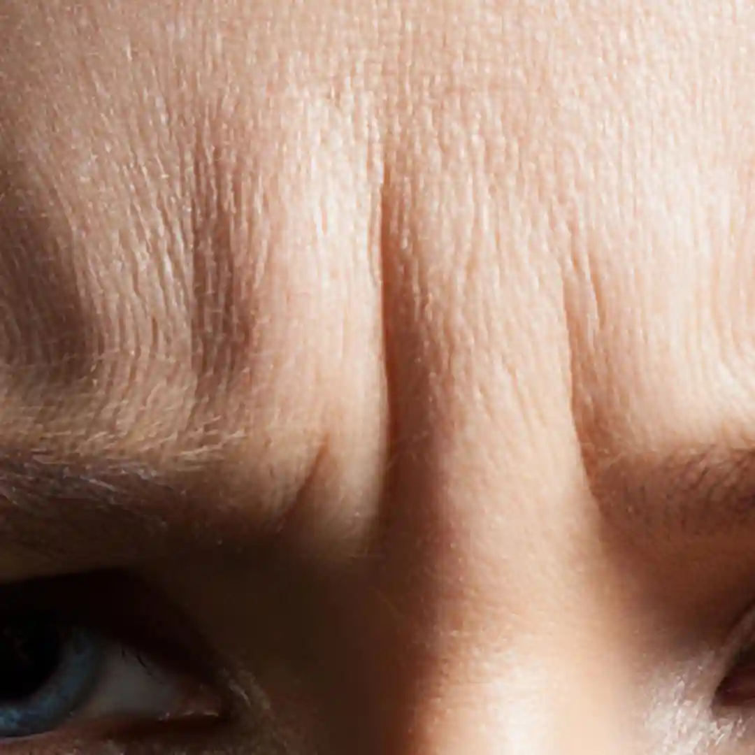 removing-wrinkles-eyelash-clinic-diva