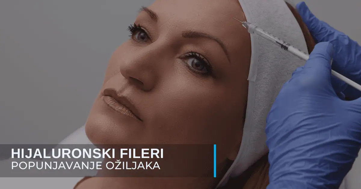 Popunjavanje ožiljaka hijaluronom poliklinika Diva dr Bogdanović