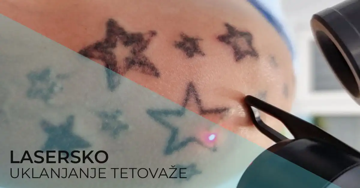 Lasersko uklanjanje tetovaža i obrva - klinika Diva