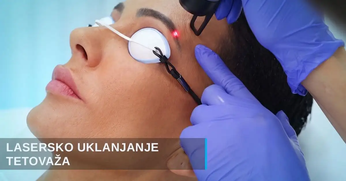 Lasersko uklanjanje tetovaža i obrva poliklinika Diva Beograd