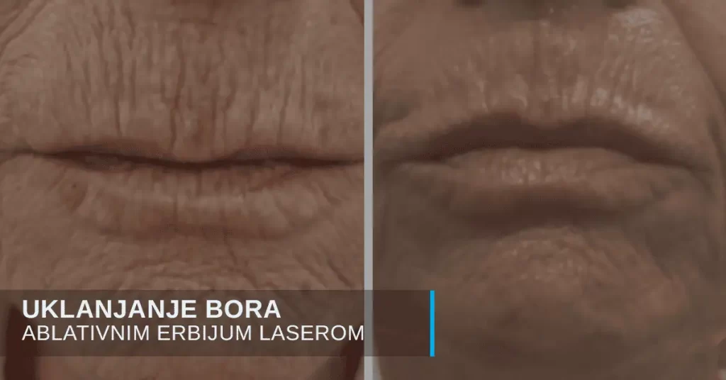 Uklanjanje bora laserom i zatezanje koze u poliklinici Diva
