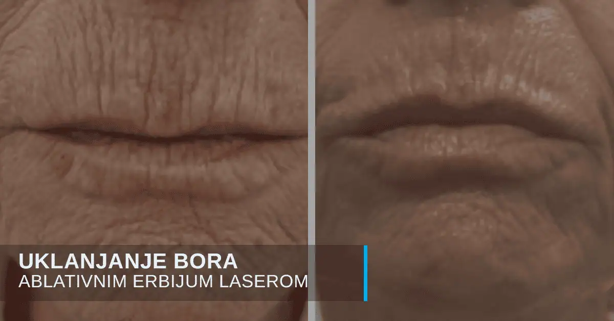 Uklanjanje bora laserom i zatezanje koze u poliklinici Diva