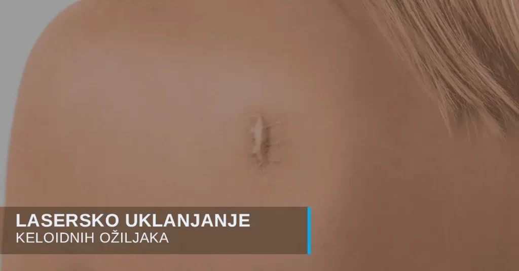 Keloidni ožiljci