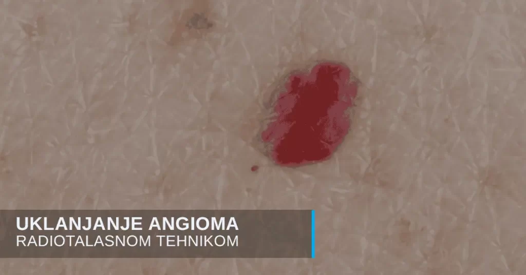Uklanjanje angioma i crvenih mladeža u poliklinici Diva