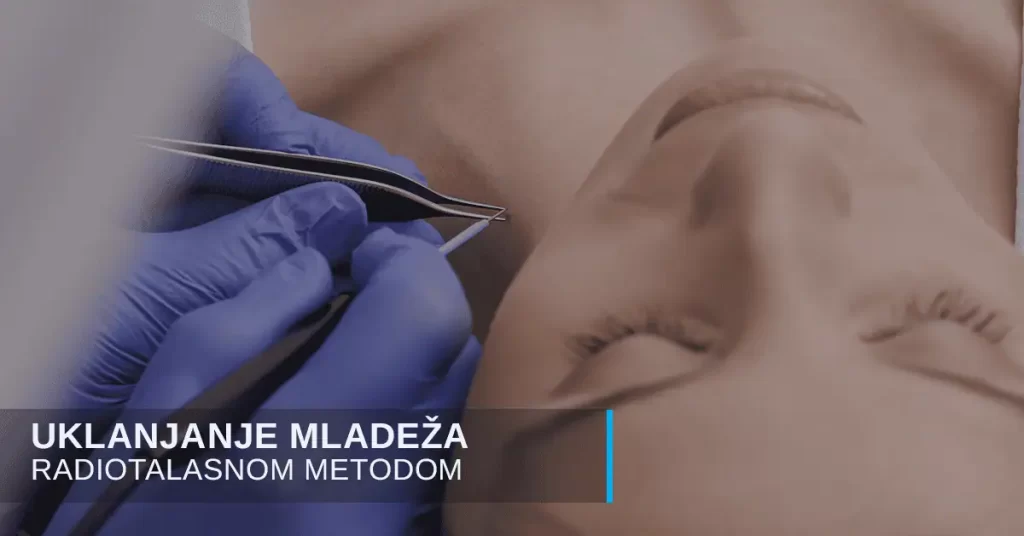 Uklanjanje mladeža radio-talasima