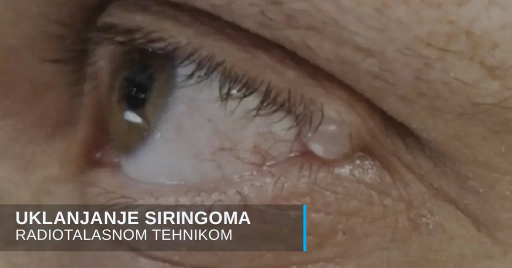 Uklanjanje siringoma