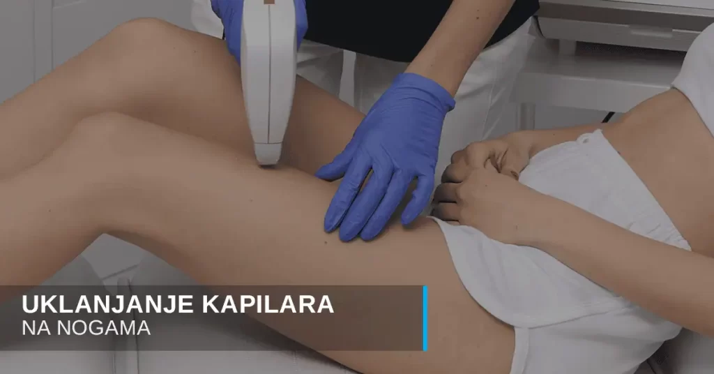 Uklanjanje kapilara na nogama laserom