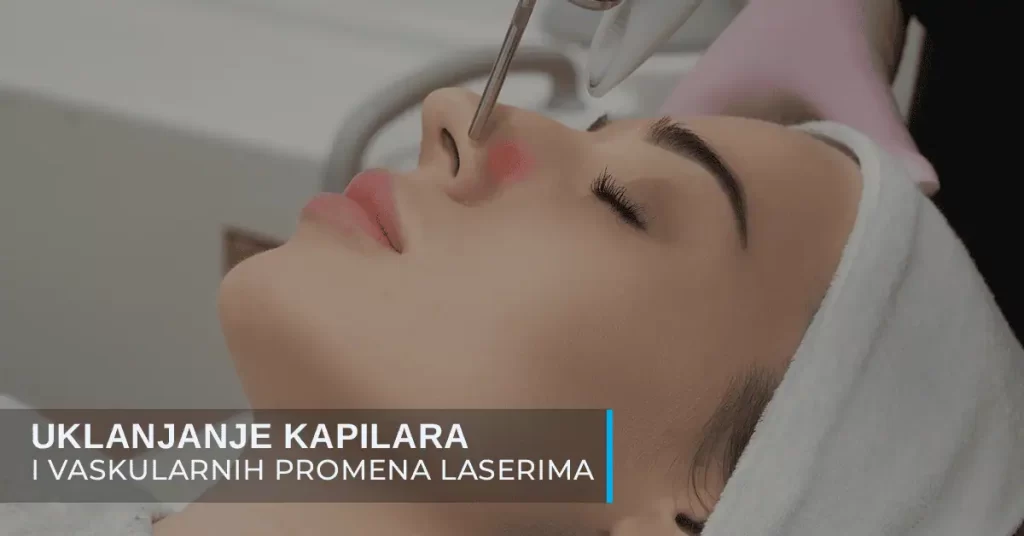 Uklanjanje kapilara i vaskularnih promena na licu i dekolteu