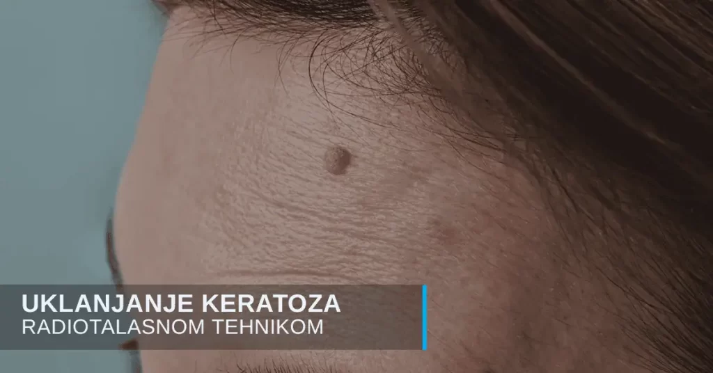 Uklanjanje keratoza radio-talasima u poliklinici Diva