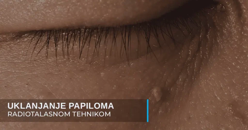 Papilomi uklanjanje radiotalasnom tehnikom u poliklinici Diva