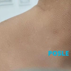 Uklanjanje bradavica posle tretmana