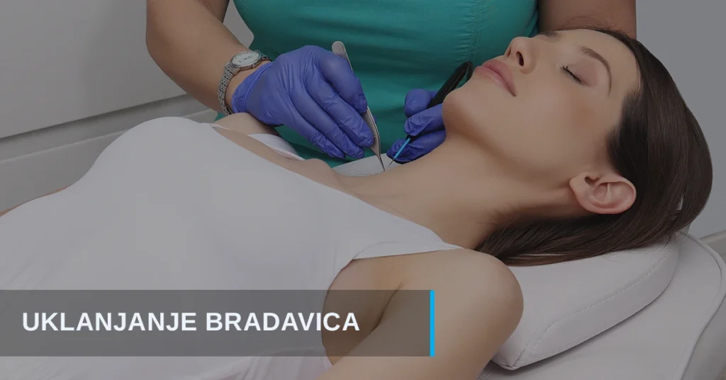 Uklanjanje bradavica
