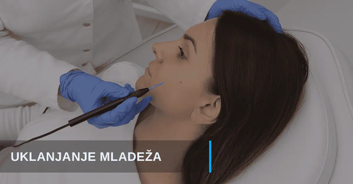 Uklanjanje mladeža Beograd Poliklinika Diva