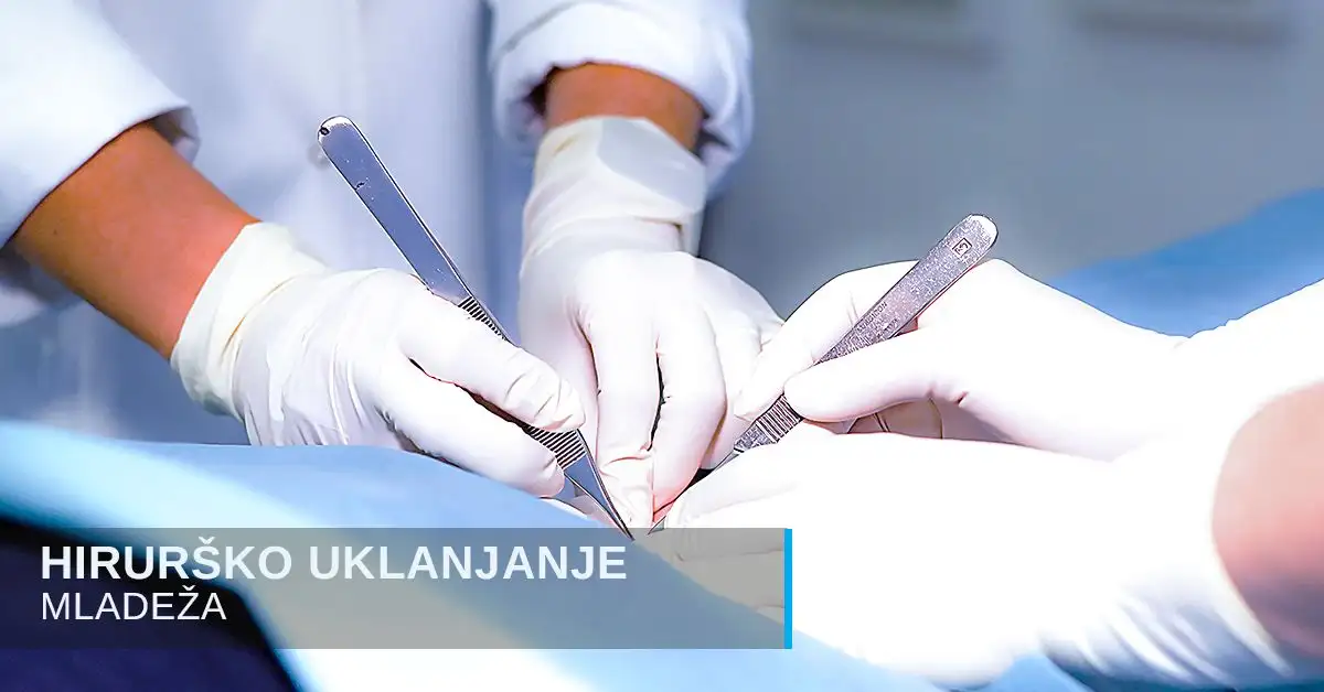 Hirurško uklanjanje mladeža poliklinika Diva